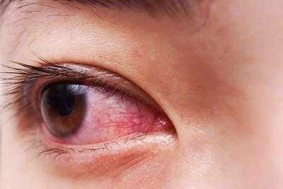 孕期害眼(孕期害眼怎么办) 第2张 孕期害眼(孕期害眼怎么办) 第2张