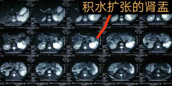 怎么能减轻胎儿肾积水,胎儿肾脏积水是什么原因引起的 第2张 怎么能减轻胎儿肾积水,胎儿肾脏积水是什么原因引起的 第2张