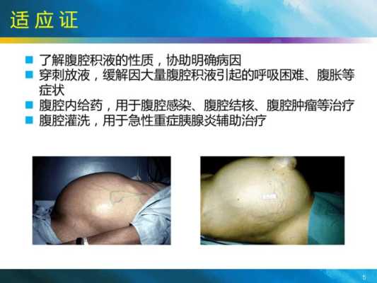 金鱼怀孕和腹水的区别,胎儿胸腹水对胎儿有什么影响 第3张 金鱼怀孕和腹水的区别,胎儿胸腹水对胎儿有什么影响 第3张