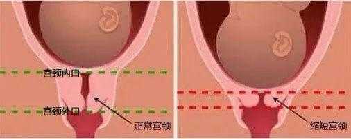 孕期宫颈缩短(孕期宫颈缩短) 第1张 孕期宫颈缩短(孕期宫颈缩短) 第1张