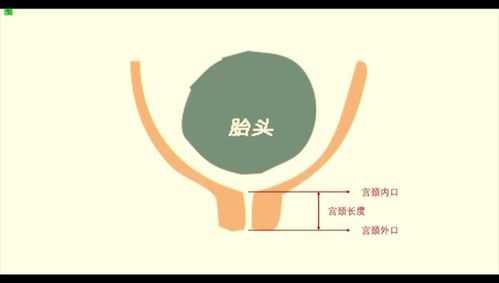 孕期宫颈缩短(孕期宫颈缩短) 第2张 孕期宫颈缩短(孕期宫颈缩短) 第2张