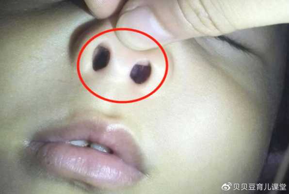 宝宝鼻子里呼哧呼哧但又不见鼻涕流出来,怎么回事,胎儿没鼻子是什么原因 第1张 宝宝鼻子里呼哧呼哧但又不见鼻涕流出来,怎么回事,胎儿没鼻子是什么原因 第1张