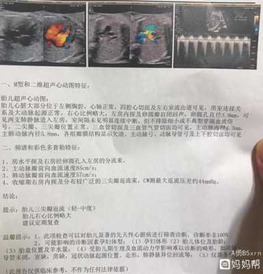 胎儿右心房增大（胎儿右心房增大）  第2张