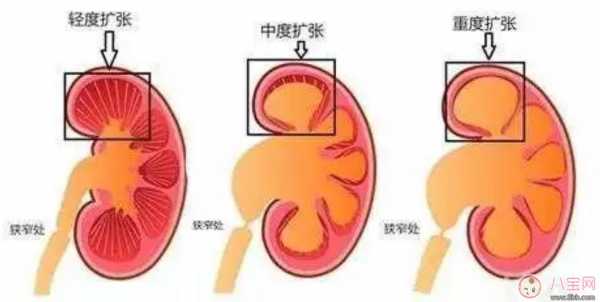 怀孕宝宝肾积水是什么原因,胎儿肾结水是什么原因引起的 第2张 怀孕宝宝肾积水是什么原因,胎儿肾结水是什么原因引起的 第2张