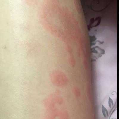 孕期腿部痒(大腿痒是什么原因) 第1张 孕期腿部痒(大腿痒是什么原因) 第1张