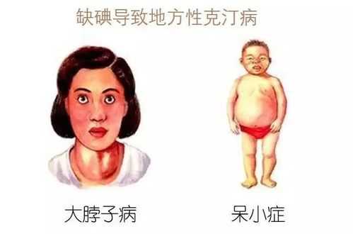 孕期碘缺乏(孕期碘缺乏可能会导致胎儿出现) 第2张 孕期碘缺乏(孕期碘缺乏可能会导致胎儿出现) 第2张