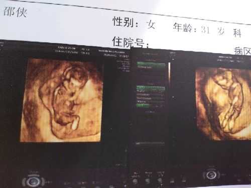 孕44天胎儿(孕44天胎儿发育情况) 第3张 孕44天胎儿(孕44天胎儿发育情况) 第3张
