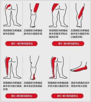 怀孕16周,腰右侧酸胀疼,怎么办,孕期腰椎痛怎么办 第2张 怀孕16周,腰右侧酸胀疼,怎么办,孕期腰椎痛怎么办 第2张
