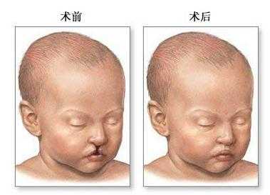 二维b超能排畸兔唇吗,胎儿二维b超图怎么看 第2张 二维b超能排畸兔唇吗,胎儿二维b超图怎么看 第2张