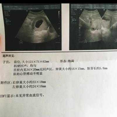 胎儿突然没有胎心原因（胎心停了几天又恢复了）  第2张