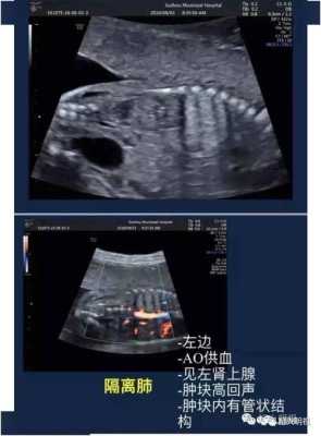 胎儿隔离肺能自愈吗(胎儿隔离肺可以自愈吗) 第2张 胎儿隔离肺能自愈吗(胎儿隔离肺可以自愈吗) 第2张