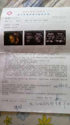 四维彩超查出宝宝肾有积水怎么办,怎么能减轻胎儿肾积水的发生  第2张
