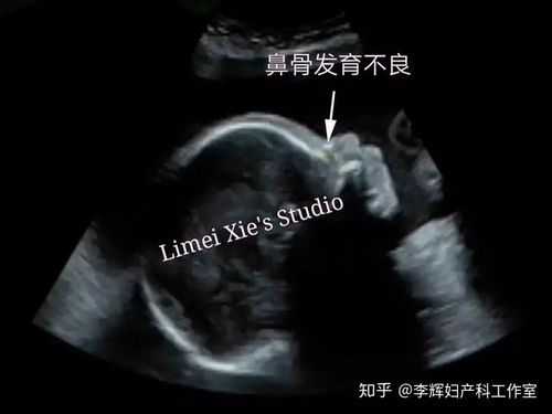 23周胎儿鼻骨正常值(23周胎儿鼻骨正常值对照表) 第2张 23周胎儿鼻骨正常值(23周胎儿鼻骨正常值对照表) 第2张