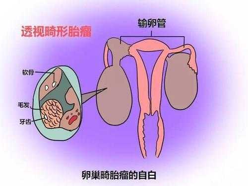 畸胎瘤到底是什么,胎儿畸胎瘤是怎么形成的原因  第1张