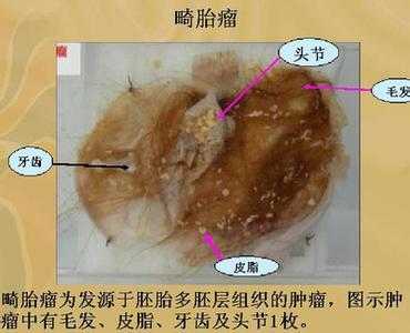 畸胎瘤到底是什么,胎儿畸胎瘤是怎么形成的原因  第2张