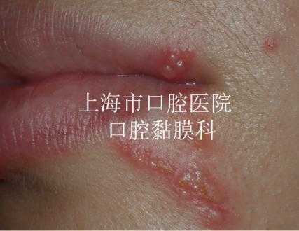 唇疱疹的发病原因,孕期唇疱疹会影响胎儿吗 第1张 唇疱疹的发病原因,孕期唇疱疹会影响胎儿吗 第1张