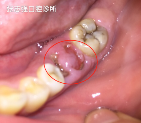 孕期牙断裂(牙齿断裂的原因) 第1张 孕期牙断裂(牙齿断裂的原因) 第1张