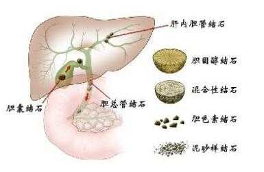 胎儿胆结石(胎儿胆结石怎么引起的) 第2张 胎儿胆结石(胎儿胆结石怎么引起的) 第2张
