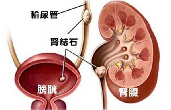 哺乳期肾结石怎么办,胎儿肾结石是怎么形成的  第2张