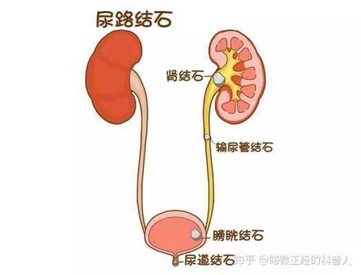 哺乳期肾结石怎么办,胎儿肾结石是怎么形成的  第1张