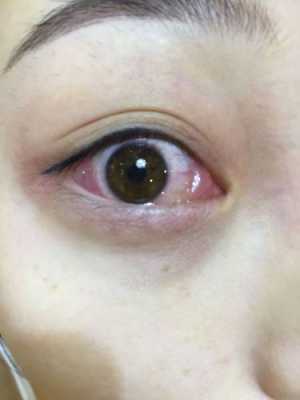 眼睛痒是怎么回事，眼睛痒是什么原因引起,孕期眼睛痒怎么办越揉越痒  第2张