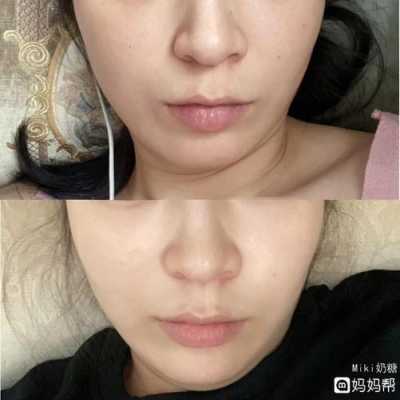 孕期鼻头变大(鼻头变大是怎样造成的) 第2张 孕期鼻头变大(鼻头变大是怎样造成的) 第2张