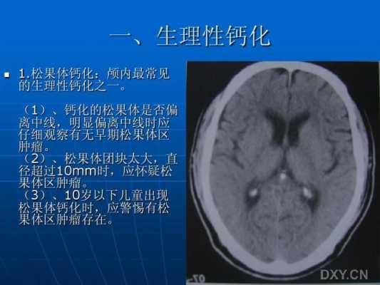 胎儿脑钙化(胎儿脑钙化是什么意思) 第2张 胎儿脑钙化(胎儿脑钙化是什么意思) 第2张