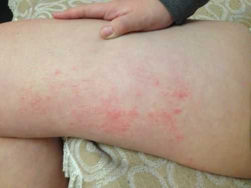 孕期大腿内侧红了一块,又痛是怎么回事,孕期大腿根部红肿疼痛 第1张 孕期大腿内侧红了一块,又痛是怎么回事,孕期大腿根部红肿疼痛 第1张