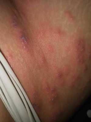 孕期大腿内侧红了一块,又痛是怎么回事,孕期大腿根部红肿疼痛 第2张 孕期大腿内侧红了一块,又痛是怎么回事,孕期大腿根部红肿疼痛 第2张