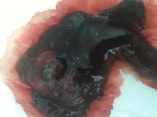 流产胎儿血(流产后血液中还有胎儿基因吗) 第2张 流产胎儿血(流产后血液中还有胎儿基因吗) 第2张