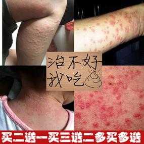 孕期皮炎图片大全(孕妇得了湿疹用什么药?孕妇身上长湿疹会对胎儿有影响吗) 第1张 孕期皮炎图片大全(孕妇得了湿疹用什么药?孕妇身上长湿疹会对胎儿有影响吗) 第1张