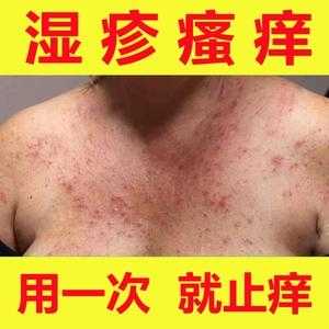 孕期皮炎图片大全(孕妇得了湿疹用什么药?孕妇身上长湿疹会对胎儿有影响吗) 第2张 孕期皮炎图片大全(孕妇得了湿疹用什么药?孕妇身上长湿疹会对胎儿有影响吗) 第2张