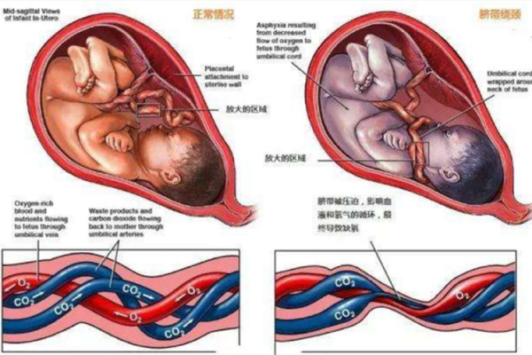 胎儿绕劲(胎儿绕颈2周怎样能绕过来) 第2张 胎儿绕劲(胎儿绕颈2周怎样能绕过来) 第2张