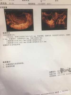 孕期宫内积液(孕期出血宫腔有激液怎么办) 第1张 孕期宫内积液(孕期出血宫腔有激液怎么办) 第1张
