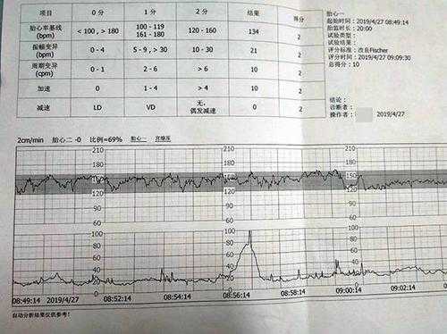 胎儿缺氧单(胎儿缺氧结果) 第2张 胎儿缺氧单(胎儿缺氧结果) 第2张