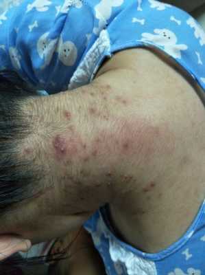 孕期脖子长痘(孕期脖子长痘痘是什么原因) 第2张 孕期脖子长痘(孕期脖子长痘痘是什么原因) 第2张