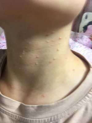 孕期脖子长痘(孕期脖子长痘痘是什么原因) 第1张 孕期脖子长痘(孕期脖子长痘痘是什么原因) 第1张