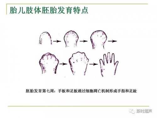 胎儿短肢畸形(胎儿短肢畸形 诊断标准) 第1张 胎儿短肢畸形(胎儿短肢畸形 诊断标准) 第1张