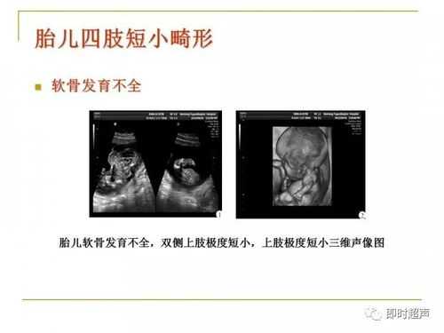 胎儿短肢畸形(胎儿短肢畸形 诊断标准) 第2张 胎儿短肢畸形(胎儿短肢畸形 诊断标准) 第2张