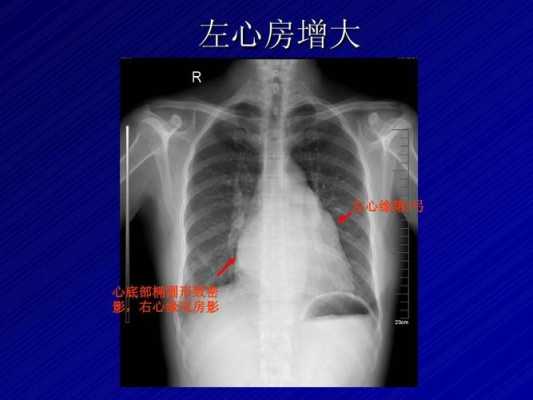 左心房增大严重吗,胎儿左心房偏大是什么原因 第1张 左心房增大严重吗,胎儿左心房偏大是什么原因 第1张