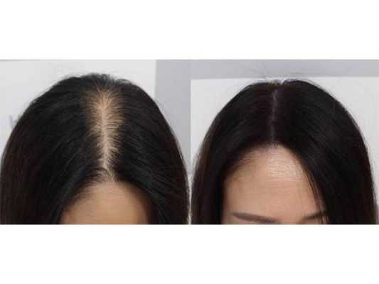头发脱发怎么办,怀孕期脱发严重怎么办 第3张 头发脱发怎么办,怀孕期脱发严重怎么办 第3张