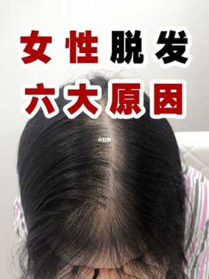 头发脱发怎么办,怀孕期脱发严重怎么办 第2张 头发脱发怎么办,怀孕期脱发严重怎么办 第2张
