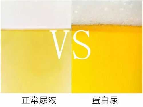 孕妇尿有泡沫是怎么回事,孕期小便有泡沫正常吗 第1张 孕妇尿有泡沫是怎么回事,孕期小便有泡沫正常吗 第1张