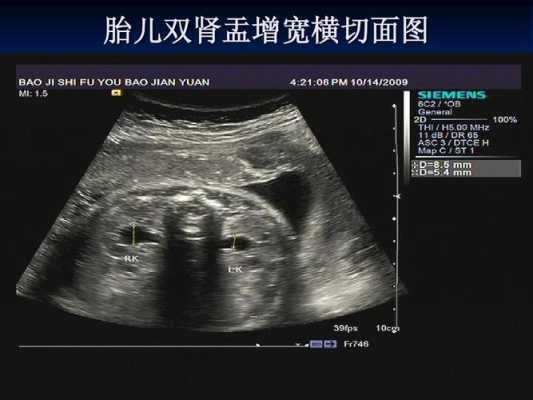 胎儿双肾盂增宽（胎儿双肾盂增宽是什么意思）  第2张