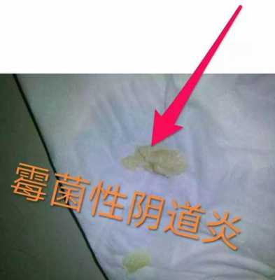 霉菌对胎儿的危害（霉菌对胎儿的危害有哪些）  第2张