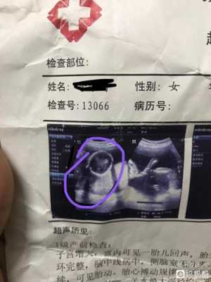 怀孕18周做什么检查,18周胎儿彩超图片 第2张 怀孕18周做什么检查,18周胎儿彩超图片 第2张