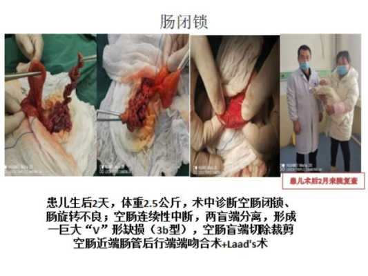 胎儿腹腔囊肿是畸形吗(胎儿腹腔囊肿是畸形吗怎么治疗) 第2张 胎儿腹腔囊肿是畸形吗(胎儿腹腔囊肿是畸形吗怎么治疗) 第2张