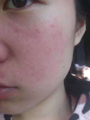 孕期脸上过敏怎么办,孕期脸上过敏红肿痒怎样快速消除 第3张 孕期脸上过敏怎么办,孕期脸上过敏红肿痒怎样快速消除 第3张