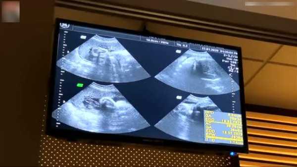 怀孕36周胎宝宝有多大,怀孕36周胎儿彩超检查面部四肢 第2张 怀孕36周胎宝宝有多大,怀孕36周胎儿彩超检查面部四肢 第2张