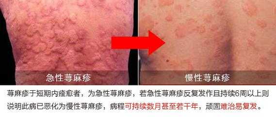 孕期寻麻疹图片(孕妇反复得荨麻疹要怎么治疗) 第2张 孕期寻麻疹图片(孕妇反复得荨麻疹要怎么治疗) 第2张